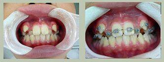 八重歯の治療