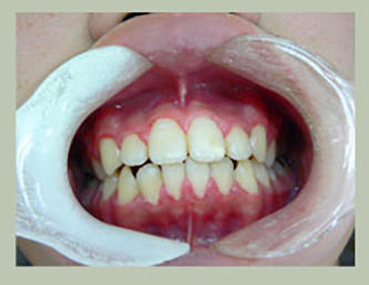 八重歯の治療
